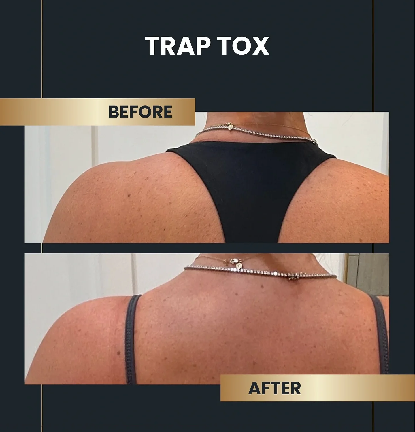 trap tox before and after