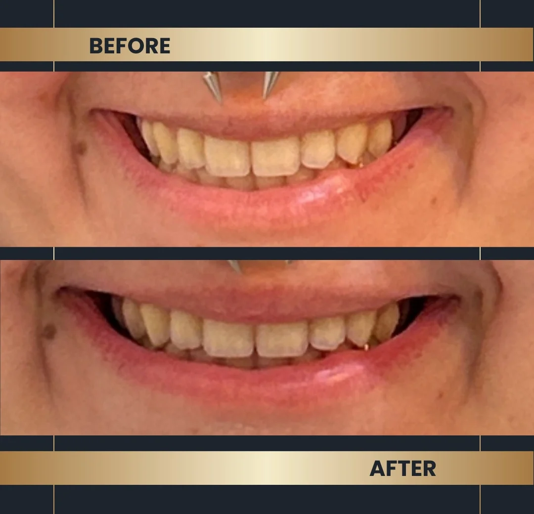 lip flip before and after