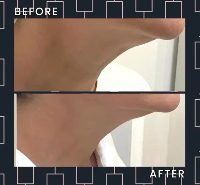 ultherapy before and after
