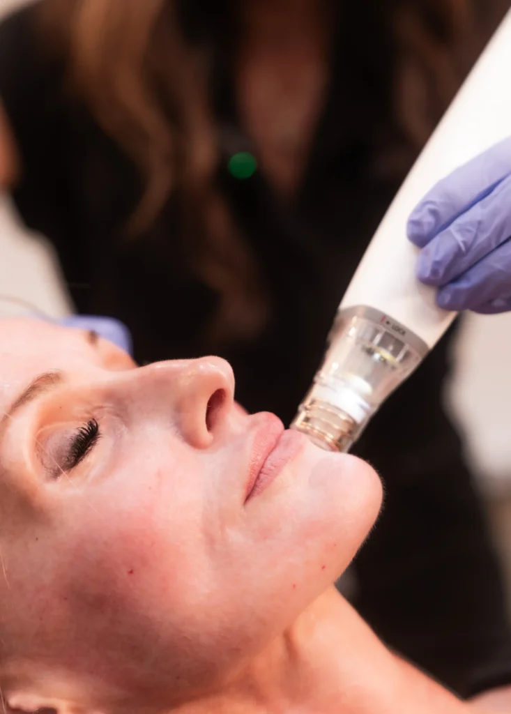 potenza rf microneedling staten island ny