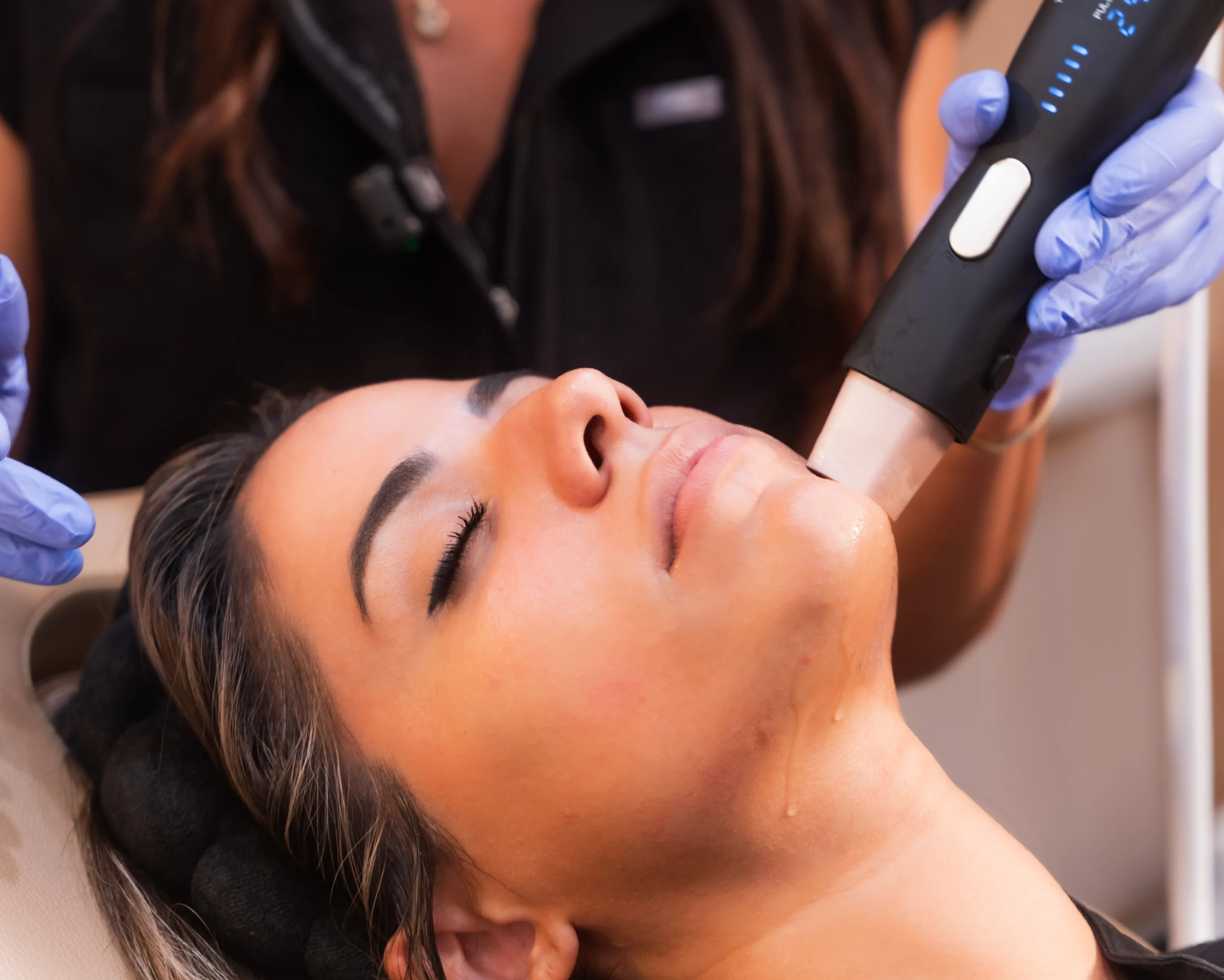 RF skin tightening in Staten Island with Density by Jeisys
